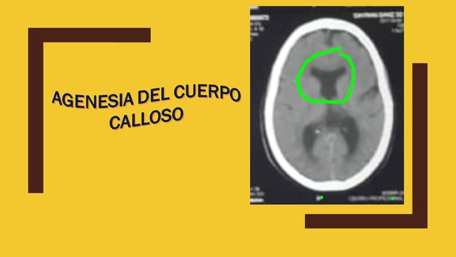 agenesia parcial de la resonancia del cuerpo calloso
